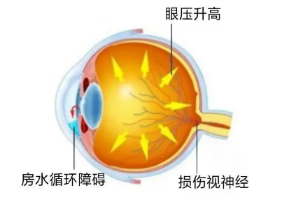 【合肥愛(ài)爾】青光眼嚴(yán)重嗎？它可能會(huì)致盲！