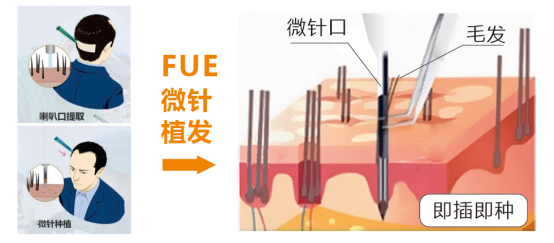 杭市一祝飛醫(yī)生植發(fā):實(shí)現(xiàn)科技創(chuàng)新性升級,賦能高品質(zhì)植發(fā)體驗(yàn)