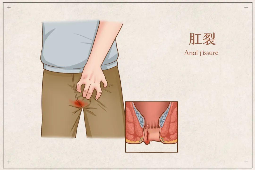 包頭東大肛腸?？漆t(yī)院詳解肛裂難以自愈，怎樣治療？