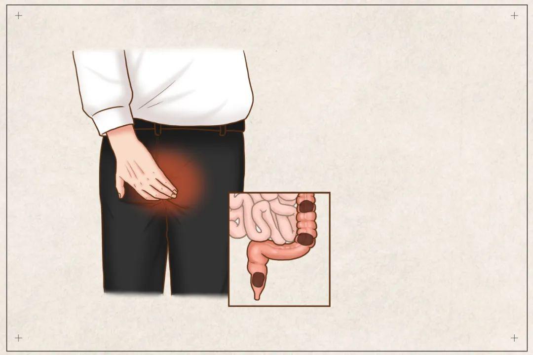 包頭東大肛腸?？漆t(yī)院詳解頻繁“肛門墜脹”