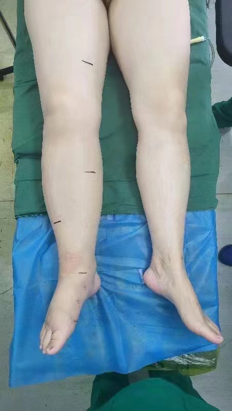 兩條腿突然變成一個粗一個細(xì)，不能從事體力勞動，全國各地到處尋醫(yī)沒有良好的治療方案