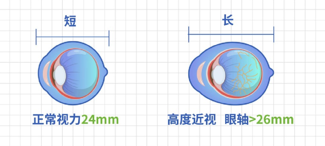 合肥愛(ài)爾眼科：盡早做好青少年近視防控，遠(yuǎn)離高度近視危害！