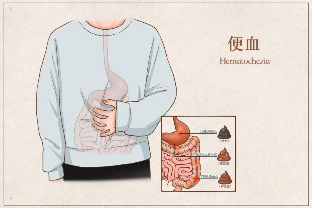 包頭東大肛腸?？漆t(yī)院詳解上廁所屁股眼出血？大便帶血是什么疾??？