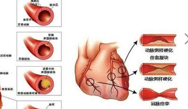 冠心病吃什么好？治療冠心病要多少錢？