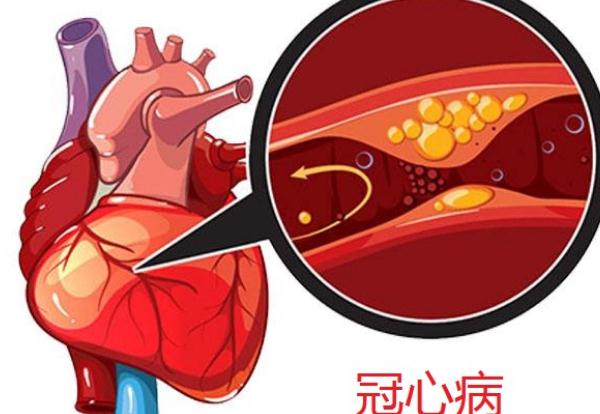 冠心病會(huì)引起頭暈嗎？冠心病會(huì)引起腳腫嗎？