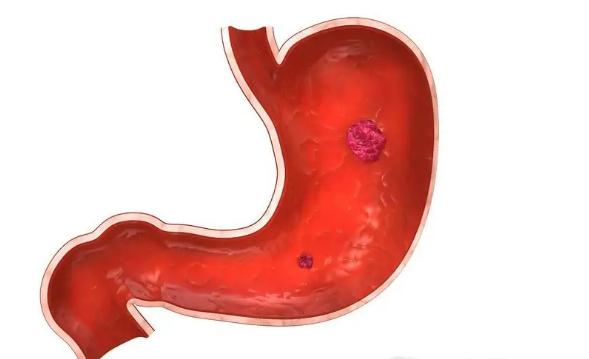 節(jié)食減肥會得胃癌嗎 ？全球胃癌患者一半在中國？