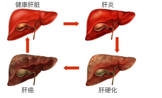 丁型肝炎有什么危害呢？丁型肝炎的癥狀有什么呢？