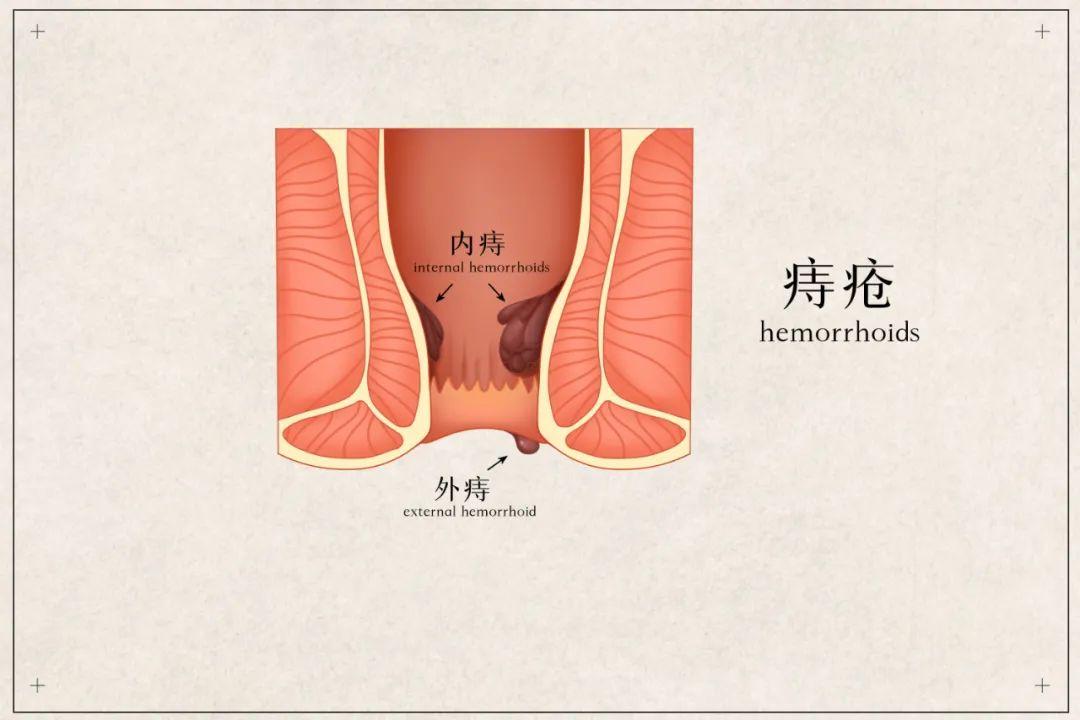 包頭東大肛腸?？漆t(yī)院詳解大便出血是痔瘡還是肛裂,你會分辨嗎?