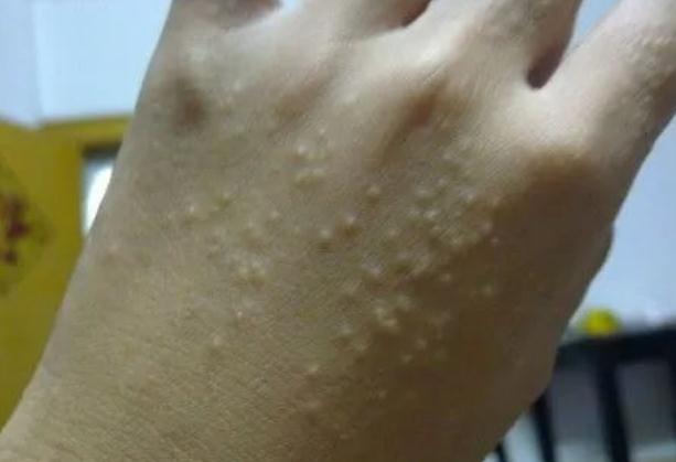 皮膚癌早期癥狀會癢嗎？皮膚癌可以喂母乳嗎？