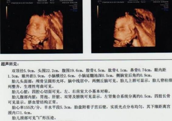 四維不檢查耳朵是真的嗎 四維彩超檢查哪些內容