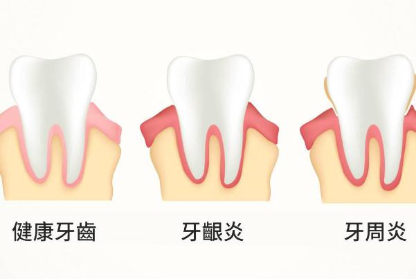 牙周炎能吃海鮮嗎？牙周炎如何自我判斷？