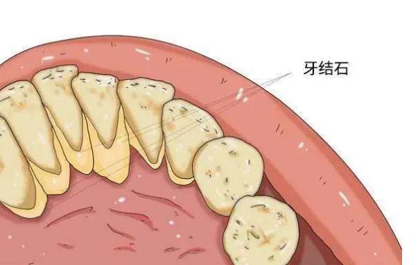牙周炎可以用沖牙器嗎 ？牙周炎吃什么好？