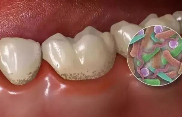 牙周炎病因？牙周炎典型癥狀？