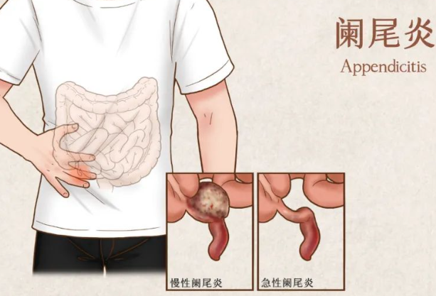 為什么會得急性闌尾炎 怎么預防急性闌尾炎