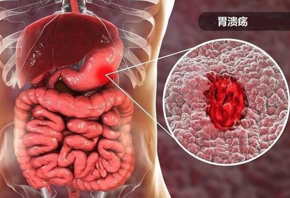 胃潰瘍會拉肚子嗎 胃潰瘍肚子會痛嗎