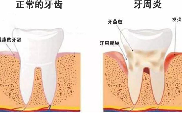 牙周炎檢查？牙周炎小偏方？