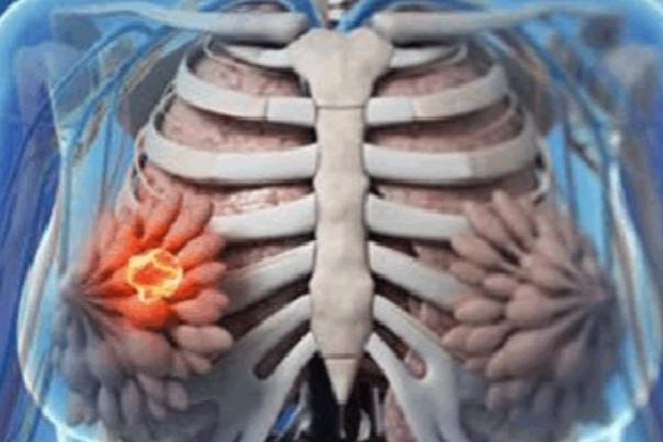 乳腺癌冷凍治療原理？冷凍治療乳腺癌大?。? data-resizeimgcut=