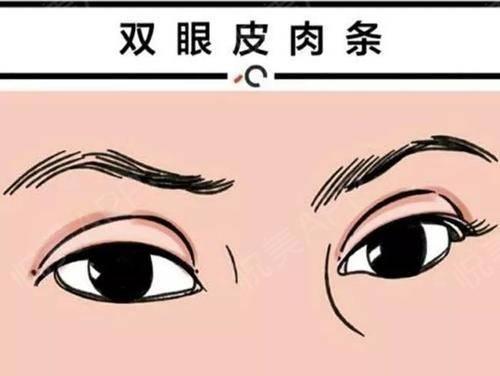 王海木美學課堂：了解成因，避開雙眼皮肉條感