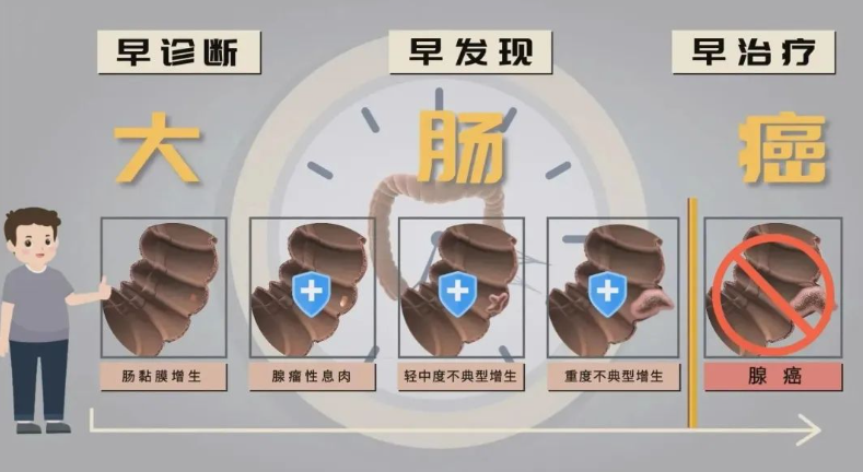丁義山：腸道里的息肉需要切除嗎？不切除會(huì)不會(huì)癌變