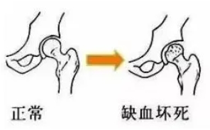 壞死的股骨頭也能新生，獲得國家認(rèn)證的股骨頭壞死早期有效治愈方法