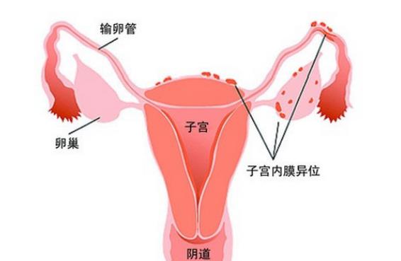 卵巢囊腫可以治好嗎 左側卵巢囊腫怎么辦