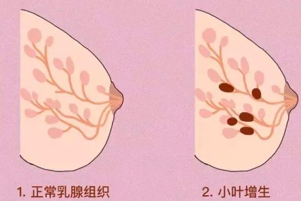內分泌絮亂會導致乳腺增生嗎 乳腺增生腋窩里會疼嗎