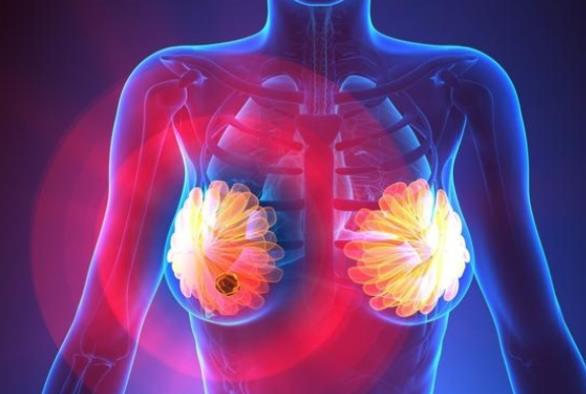 乳腺結節(jié)會遺傳嗎 乳腺結節(jié)的病因是什么
