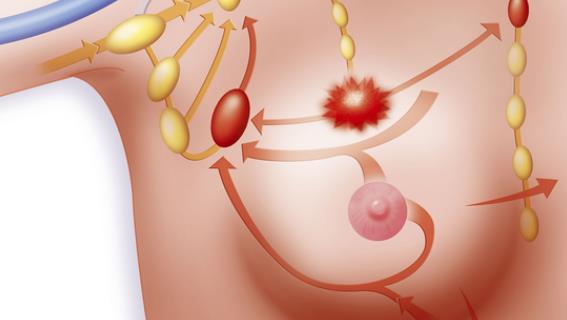乳腺結(jié)節(jié)會自己消失嗎 乳腺有結(jié)節(jié)是否需要治療
