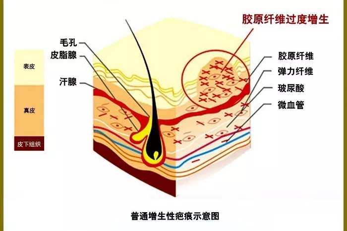 【沈陽膚康疤痕科普】之紋身疤痕，紋身雖美，疤痕防治不可忽視