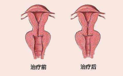 你想了解陰道緊縮術(shù)的費用嗎？往下看