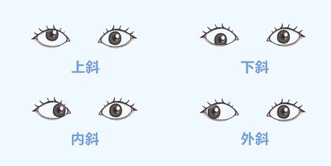 【合肥愛(ài)爾】帶您了解青少年近視防控9大誤區(qū)！