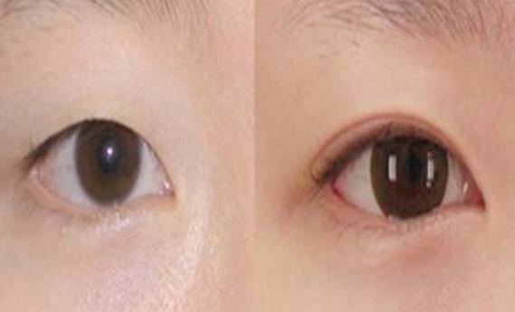 腫泡眼可以做雙眼皮嗎 腫泡眼適合哪種雙眼皮