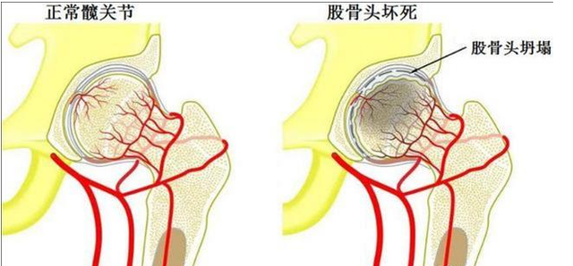 慎用激素藥！激素導(dǎo)致股骨頭壞死不要怕，通血生骨方純中藥調(diào)理，從根源治療！