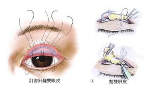 雙眼皮修復(fù)寬改窄好容易嗎 雙眼皮寬改窄修復(fù)多少錢(qián)