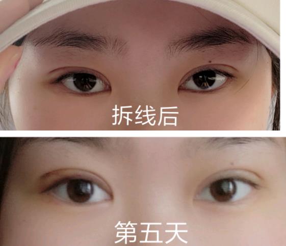 本來(lái)是雙眼皮還能再做雙眼皮嗎 怎樣不用開刀變成雙眼皮
