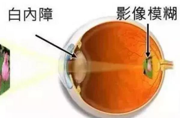 白內障手術后會痛嗎 白內障手術后會失明嗎