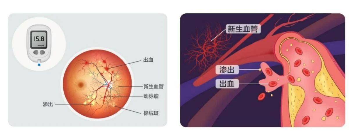 【合肥愛爾】得了糖尿病，為什么醫(yī)生讓我看眼科？