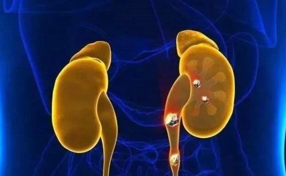 腎結石能排出來嗎 腎結石到達膀胱能排出嗎