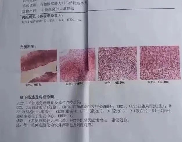 發(fā)熱原因不明，PET-CT診斷罕見成人斯蒂爾病