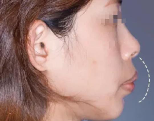遼寧杏林整形：凸嘴、臉歪…真的要丑一輩子嗎？
