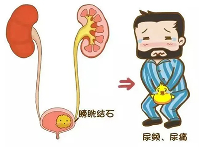 七旬老人“深陷”結(jié)石之痛，合肥中山結(jié)石醫(yī)院微創(chuàng)碎石